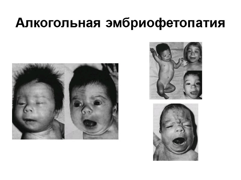 Алкогольная эмбриофетопатия